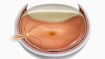 Earlier Silicone Oil Removal Linked to Less Visual Loss