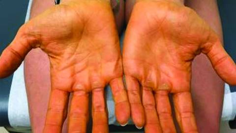 carotenoderma
