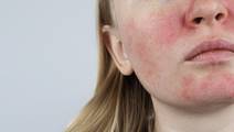 Face eczema