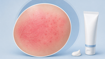 topical rosacea therapies compared in network meta analysis