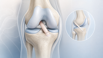 self directed psychological support after acl reconstruction fell short