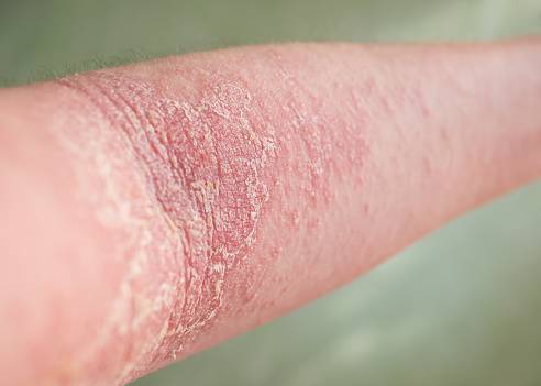Atopic Dermatitis