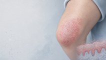 psoriasis disease activity linked to specific sleep dysfunction