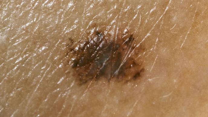 skin cancer