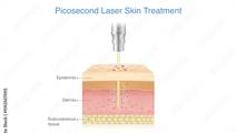 Picosecond laser