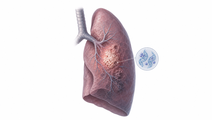 FGFR1 Gain Linked to Shorter PFS in Advanced LUSC