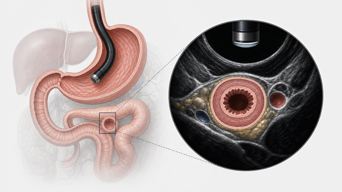 Endoscopic ultrasound anatomy showing stomach and cross sectional target bowel loop in EUS guided gastroenterostomy