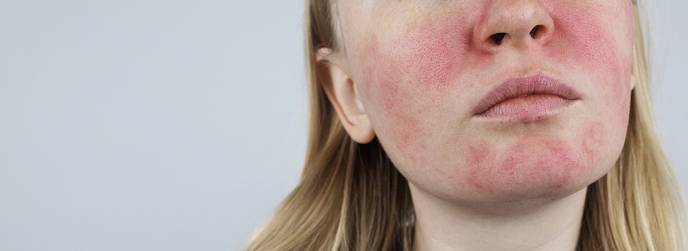 Face eczema