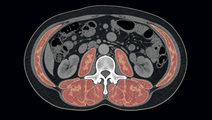 Abdominal CT slice showing low skeletal muscle mass and density in a cancer patient