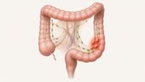 Colorectal cancer anatomy with highlighted regional lymph nodes suggesting metastasis risk