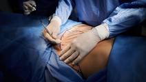 abdominoplasty