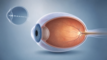 MRI Eye Shape Linked to Faster High Myopia Progression