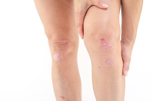 Psoriatic arthritis