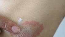 Atopic dermatitis