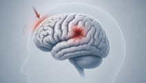 Simplified brain illustration showing traumatic intracranial hemorrhage after a ground level fall
