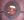 Figure 5. The irrigation handpiece and the Sinskey hook are used at the haptic-optic junction to rotate the toric IOL.