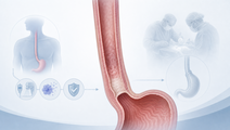 Simplified esophagus showing active surveillance after complete clinical response in esophageal cancer