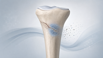 intrawound tobramycin plus vancomycin in tibial fracture fixation