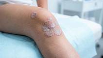 pediatric psoriasis