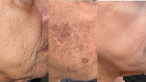 Combination Treatment Focused on a Noninvasive Approach to Facial Rejuvenation
