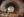 Figure 1. Dense cataract and corneal scarring in the left eye.