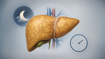 Stylized liver with steatosis cues beside sleep moon and nap clock representing MASLD risk