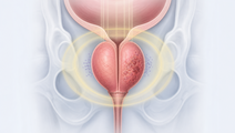 Simplified prostate gland with adverse pathology cues and radiotherapy context
