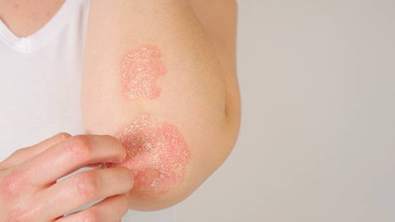 psoriasis