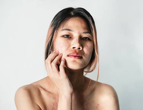 Atopic dermatitis