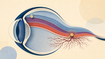 Eye cross section showing chorioretinal and intraretinal Candida endophthalmitis lesions