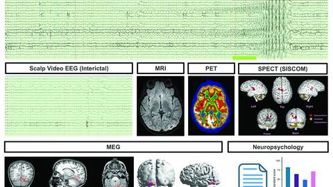 Ihnen and Arya Epilepsy Essentials column article figure 1