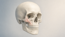 Simplified skull illustration highlighting a facial fracture in a restrained clinical color palette