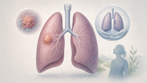 Lung Transplant Linked to Better 1 Year Survival in NSCLC
