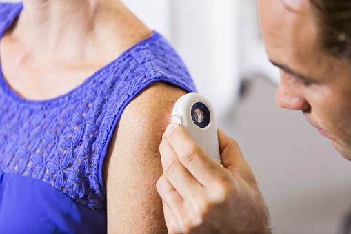 melanoma detection