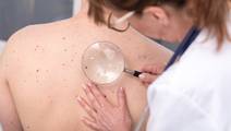 skin cancer