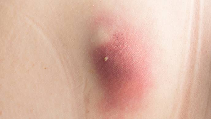 hidradenitis suppurativa