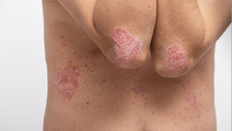 Psoriasis