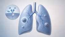Mefatinib Improves PFS vs Gefitinib in EGFR Mutated NSCLC
