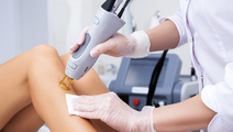 Laser hair removal