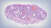 external validation of deep learning for dysplastic barretts esophagus