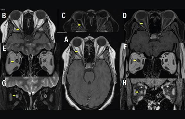 Neuro Ophthalmology Notions The Optic Nerve as Topographic Marker in the 2024 McDonald Diagnostic Criteria for Multiple Scle