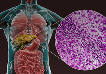 Treatment Strategies for Nonalcoholic Fatty Liver Disease: Part 1