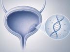 urine tumor dna stratifies recurrence risk during bcg in high risk nmibc