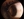 Figure 1. Keratoconus in a young patient requiring CXL.