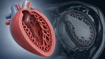 LV Hypertrabeculation Not Linked to Worse DCM Prognosis