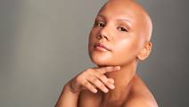 Alopecia areata