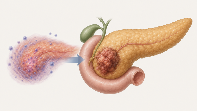 pancreatic ductal adenocarcinoma with autoimmune pancreatitis