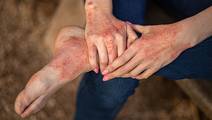 Psoriasis
