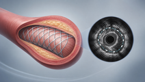 ivus guidance in complex high risk pci fails to lower tvf