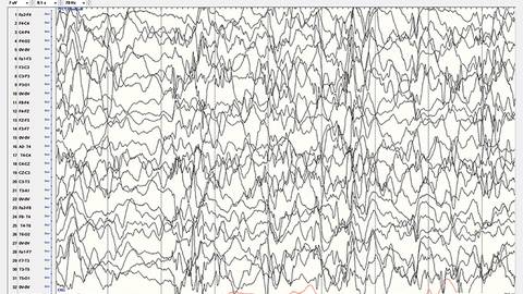 Epilepsy EssentialsInfantile Spasms The Biggest Little Seizures